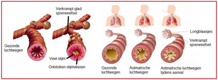 Waarom piepen je longen soms bij astma? - VND